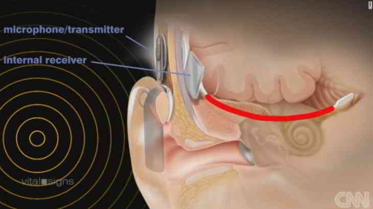 auditory-brain-implant-graphic-exlarge