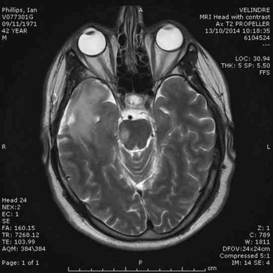 Les médecins l'ont averti que sa tumeur au cerveau reviendrait (Photo : Dimitris Legakis / Athena Pictures)