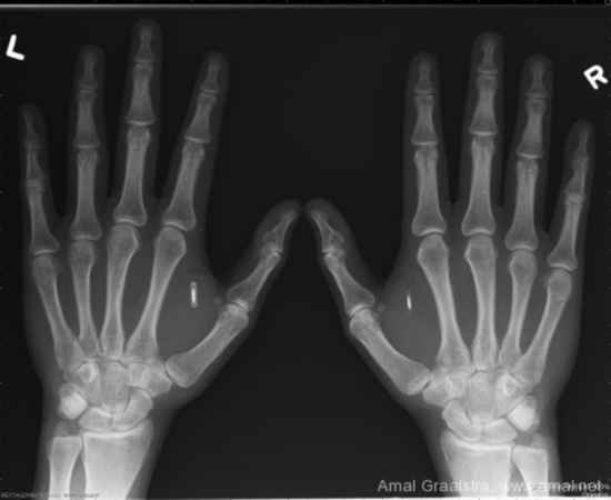 Rayons-X de puces qui ont été implantées dans les mains