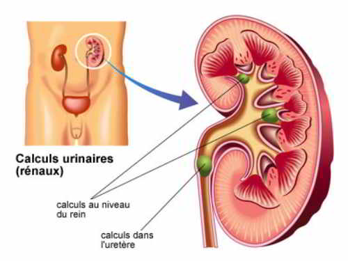 calculs-urinaires-infographie