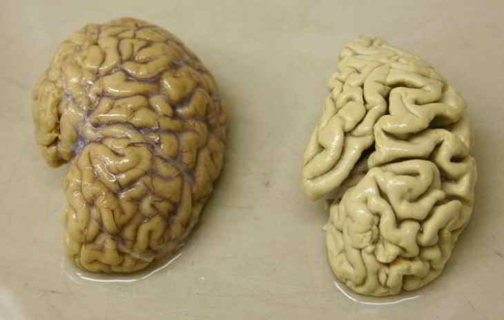 maladie-alzheimer-la mémoire
