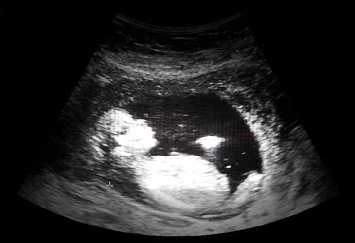 bébés prématurés